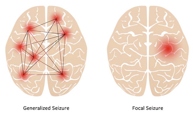 Classification of epileptic seizures
