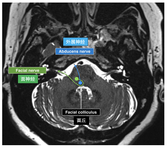 外展神经核脑干段MRI