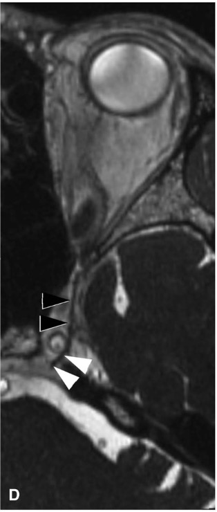 外展神经海绵窦段MRI