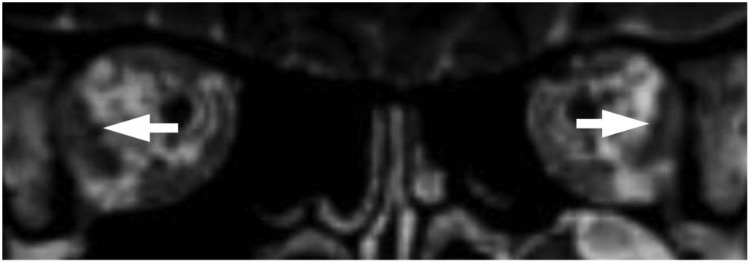 外展神经眶内段MRI