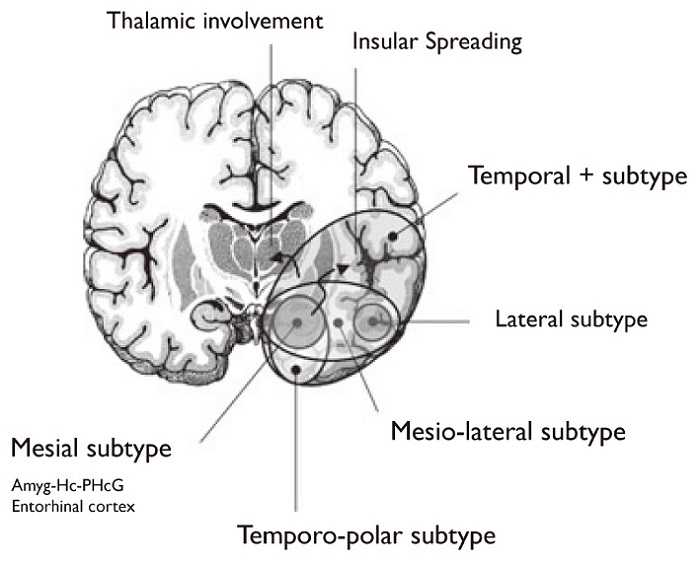 Temporal lobe epilepsy and hippocampal sclerosis